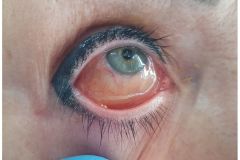 В Чувашии женщина после татуажа век получила химический ожог глаза