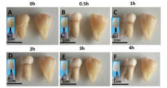 Зуб слева подвергался обработке частицами оксида титана в полидофаминовой оболочке в течение 0, 0,5, 1, 2, 3 и 4 часовКитайцы предложили абсолютно новый способ быстрого отбеливания зубов наука стоматология 