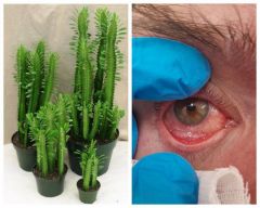 Глаз пациентаЖитель Чувашии пересаживал цветы и чуть не ослеп офтальмологическая больница 